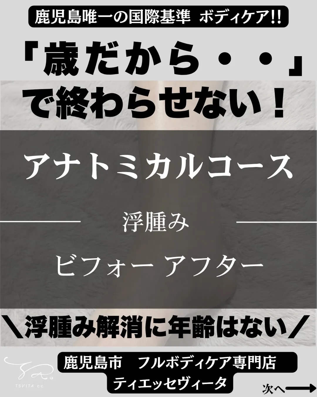 「全身浮腫みがあって…本当にきついんです」