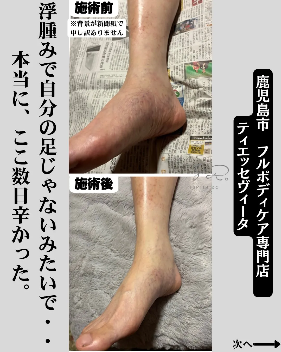 「全身浮腫みがあって…本当にきついんです」