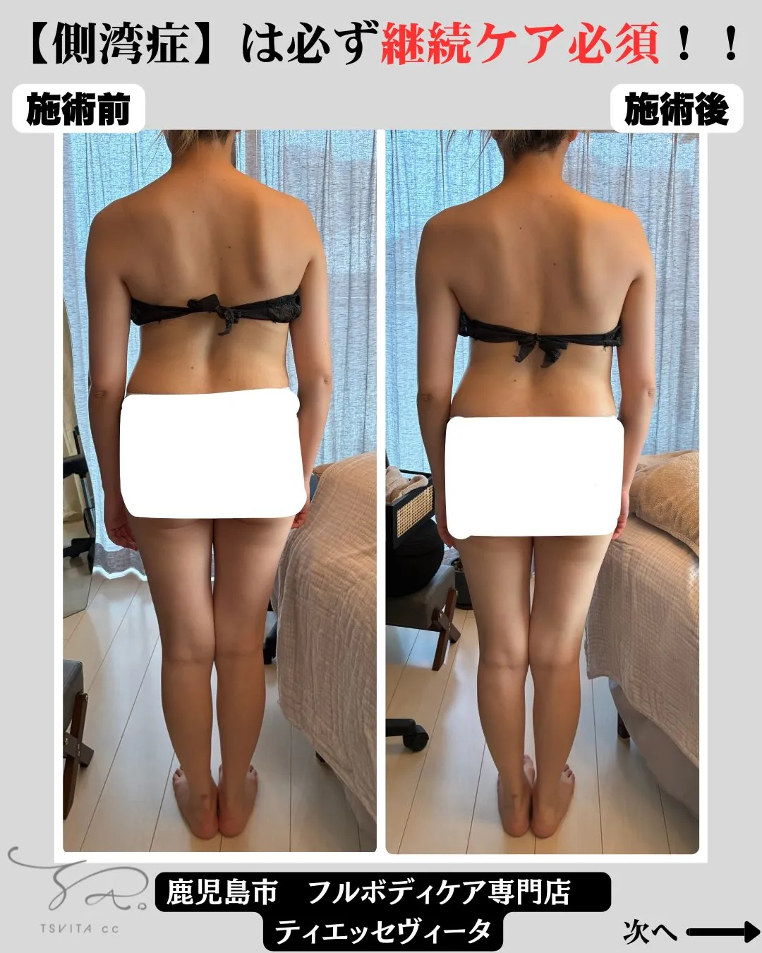 「小学生の頃に側湾症が分かって…
