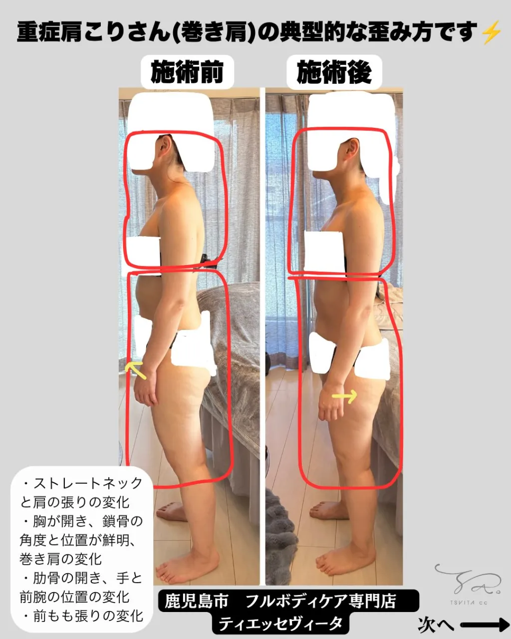 「肩こりはありますか?巻き肩ですか?」